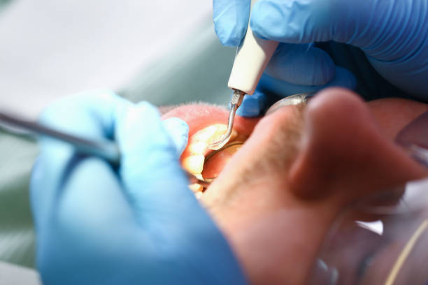 Best Broken or Chipped Tooth Repair in Alum Rock, CA